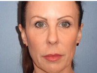 Fillers Before & After Patient #3494
