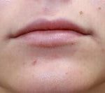 Lip Augmentation Before & After Patient #3463