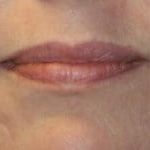 Lip Augmentation Before & After Patient #3464