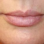Lip Augmentation Before & After Patient #3465