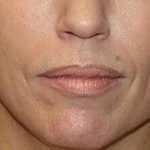 Lip Augmentation Before & After Patient #3466