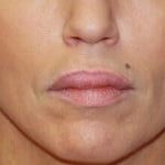 Lip Augmentation Before & After Patient #3466