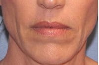 Lip Augmentation Before & After Patient #3467