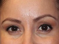 Botox Before & After Patient #3320