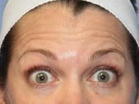 Botox Before & After Patient #3323