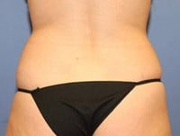 CoolSculpting Before & After Patient #3269