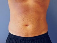 CoolSculpting Before & After Patient #3270