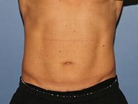 CoolSculpting Before & After Patient #3270