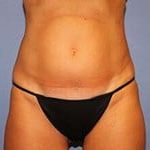 CoolSculpting Before & After Patient #3264