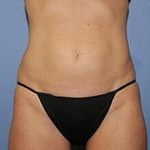 CoolSculpting Before & After Patient #3264