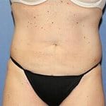 CoolSculpting Before & After Patient #3271