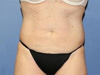 CoolSculpting Before & After Patient #3271