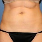 CoolSculpting Before & After Patient #3267