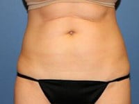 CoolSculpting Before & After Patient #3267