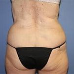 CoolSculpting Before & After Patient #3273