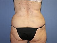 CoolSculpting Before & After Patient #3273