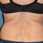 CoolSculpting Before & After Patient #3266