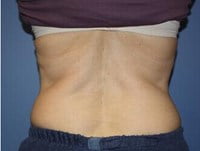 CoolSculpting Before & After Patient #3266