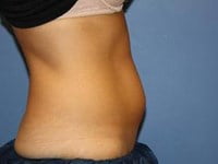 CoolSculpting Before & After Patient #3268