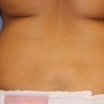 CoolSculpting Before & After Patient #3265