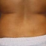 CoolSculpting Before & After Patient #3265