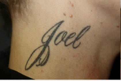 Laser Tattoo Removal Before & After Patient #3300