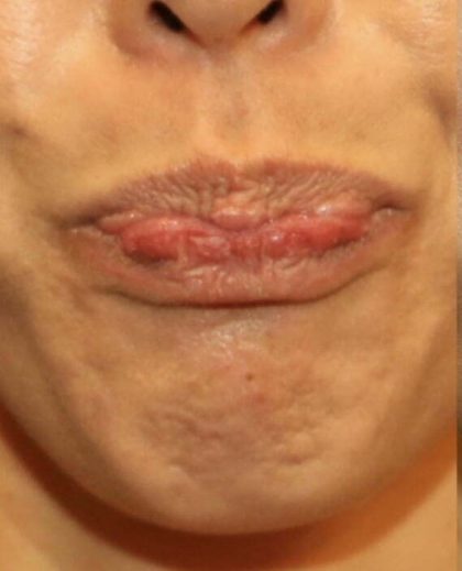 Botox Before & After Patient #3319