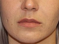 Fillers Before & After Patient #3405