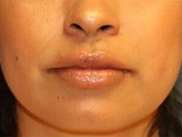 Fillers Before & After Patient #3411