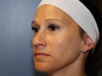 Laser Skin Resurfacing Before & After Patient #3470