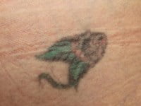 Laser Tattoo Removal Before & After Patient #3298