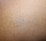 Laser Tattoo Removal Before & After Patient #3299