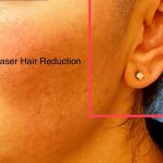 Laser Hair Reduction Before & After Patient #4226