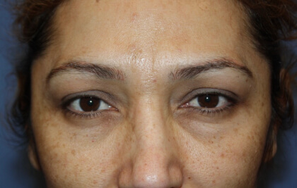 Chemical Peels Before & After Patient #4262