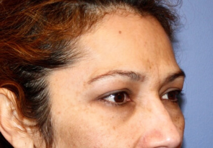 Chemical Peels Before & After Patient #4262