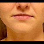 Lip Augmentation Before & After Patient #4326