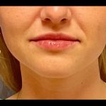 Lip Augmentation Before & After Patient #4326