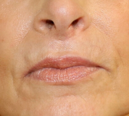 Laser Skin Resurfacing Before & After Patient #4318