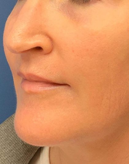 Lip Augmentation Before & After Patient #4504