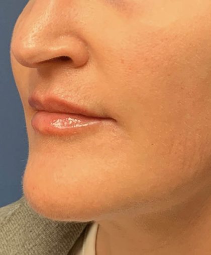 Lip Augmentation Before & After Patient #4504