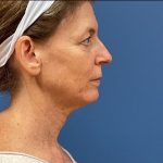 Laser Skin Resurfacing Before & After Patient #4787