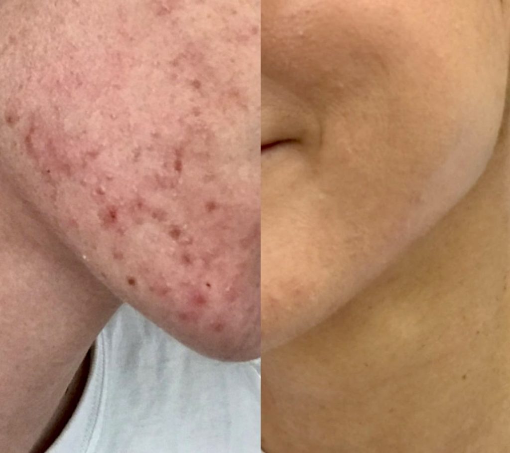 Acne/Acne Scarring