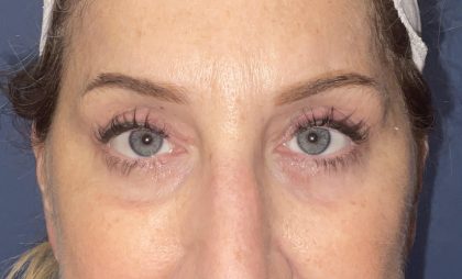 Laser Skin Resurfacing Before & After Patient #4904