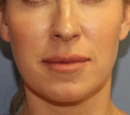 Botox Before & After Patient #4910
