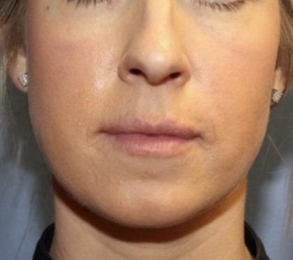 Botox Before & After Patient #4910