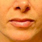 Lip Augmentation Before & After Patient #4977