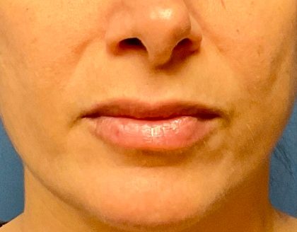 Lip Augmentation Before & After Patient #4977