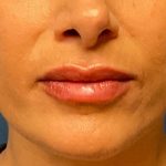 Lip Augmentation Before & After Patient #4977