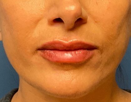 Lip Augmentation Before & After Patient #4977