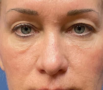 Laser Skin Resurfacing Before & After Patient #5023